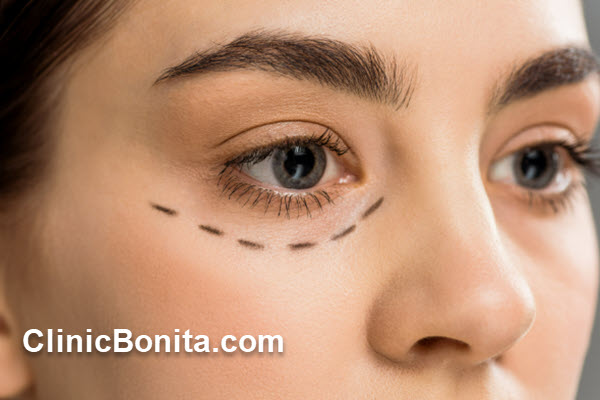 بهترین سن برای عمل بلفاروپلاستی