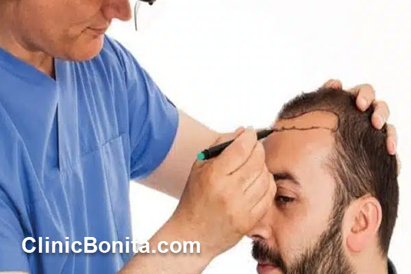 قیمت کاشت هر تار مو در اصفهان