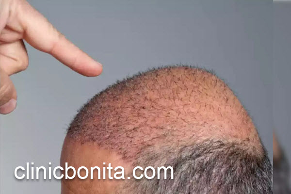 بعد از کاشت مو، چه نکاتی را باید رعایت کنیم؟