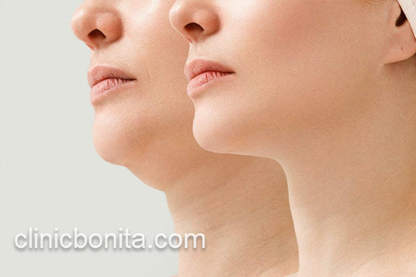 مرکز تخصصی جراحی غبغب در اصفهان | کلینیک بنیتای اصفهان