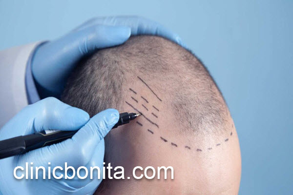 کاشت مو طبیعی چیست و چگونه انجام می گیرد؟