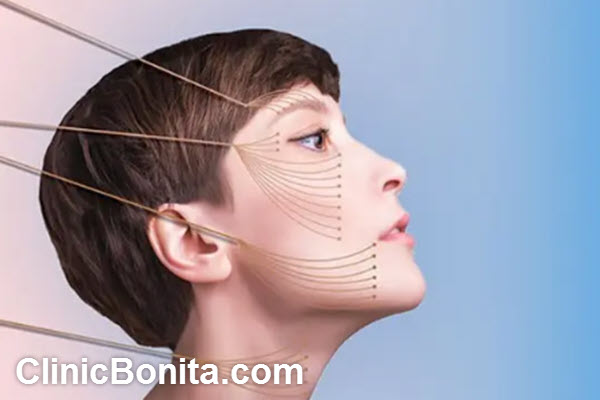 ویژگی های بهترین دکتر لیفت صورت با نخ در اصفهان